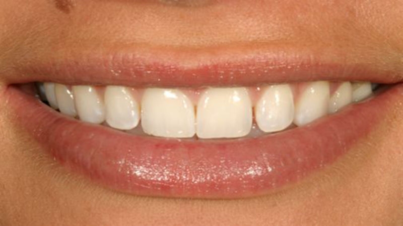 Get a Better Smile with These 5 Cosmetic Dentistry Options