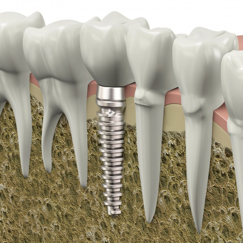 Three Compelling Advantages That Restorative Implants Offers Over Other Available Tooth Replacement Options