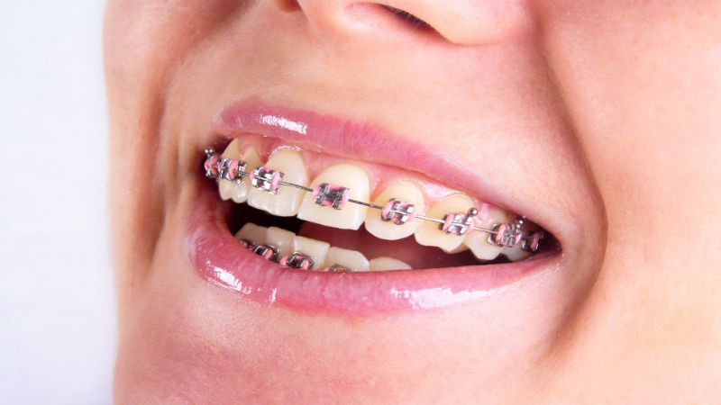 Care For Your Teeth While Wearing Braces