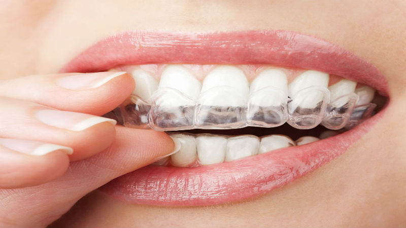 The Freedoms People Enjoy With Invisalign Treatment In Queens NY