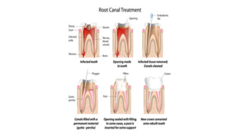 Signs You May Need a Root Canal in New Iberia, LA
