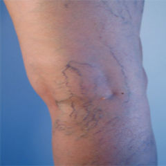 Is Sclerotherapy for Varicose Veins Right For You?