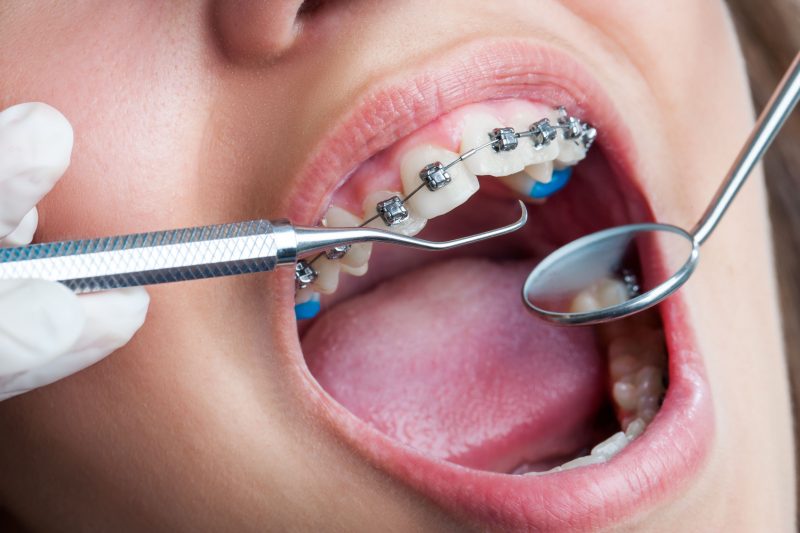 Need Braces, Visit An Orthodontist In Lombard