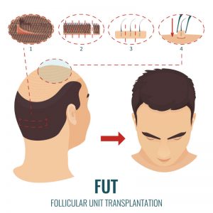 Three Things You Can Do if You’re Losing Your Hair in Connecticut