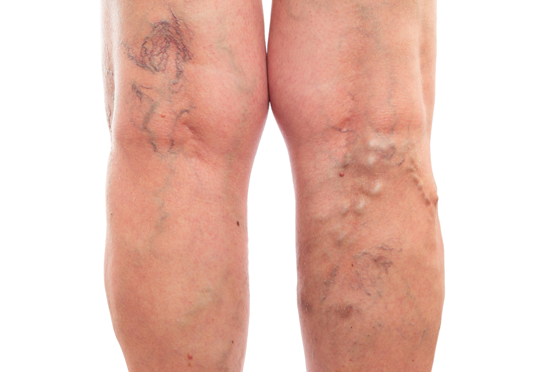 Get Your Confidence Back: Sclerotherapy Hoffman Estates IL