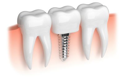 Transform Your Smile with Dental Implants Joliet: A Comprehensive Guide