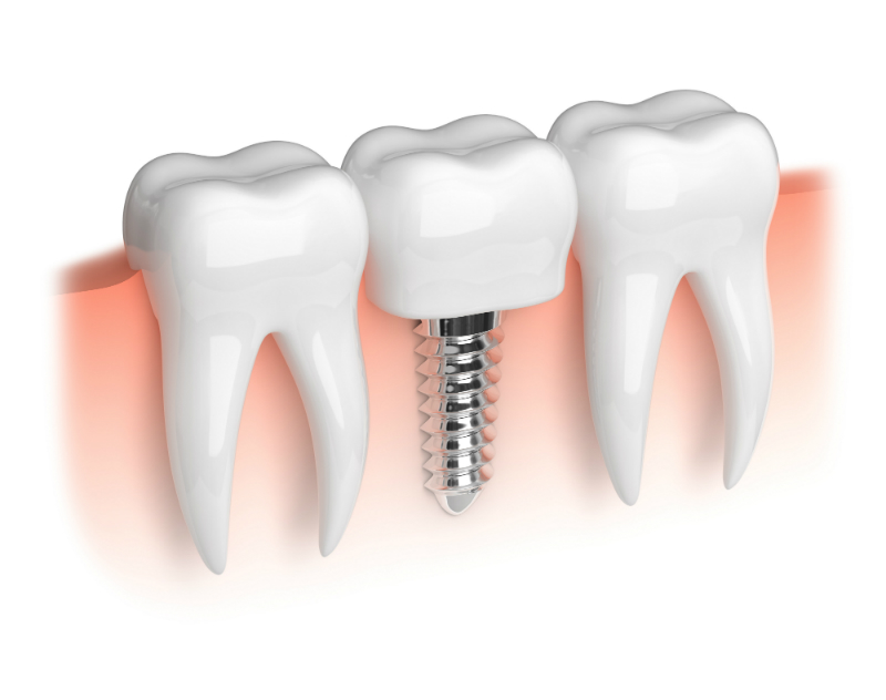 Transform Your Smile with Dental Implants Joliet: A Comprehensive Guide