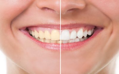 Effective Teeth Whitening Treatment Near Madison, WI: Achieve a Brighter Smile Today