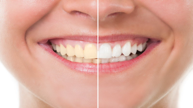 Effective Teeth Whitening Treatment Near Madison, WI: Achieve a Brighter Smile Today