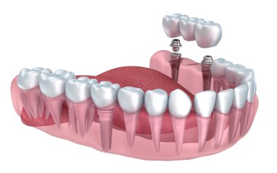 Unique Benefits of Choosing Porcelain Veneers, Isle Of Palms, SC for Your Dental Needs