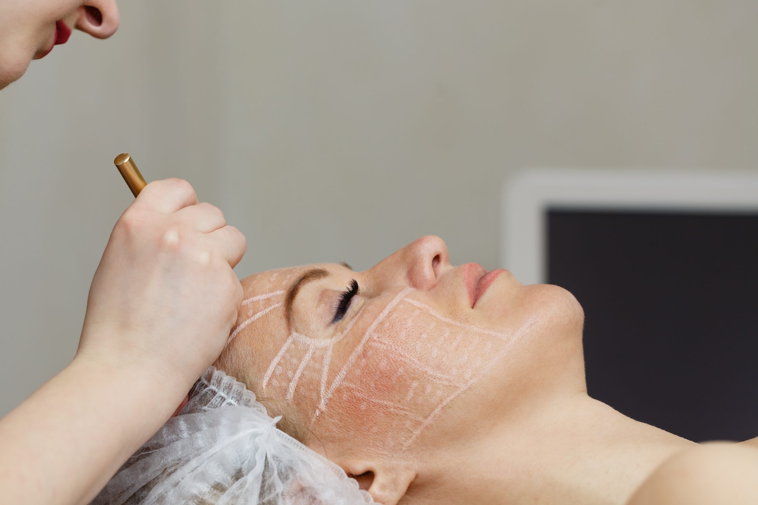 How Microneedling Treatments Help Reduce Wrinkles and Improve Skin Texture Safely in Prosper TX