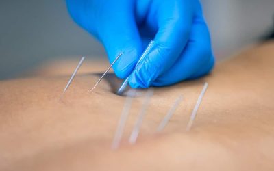 Relieve Chronic Pain Naturally with Acupuncture Fort Lupton CO Residents Trust Most