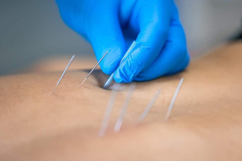 Relieve Chronic Pain Naturally with Acupuncture Fort Lupton CO Residents Trust Most